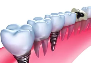 Westside LA Dental Implants